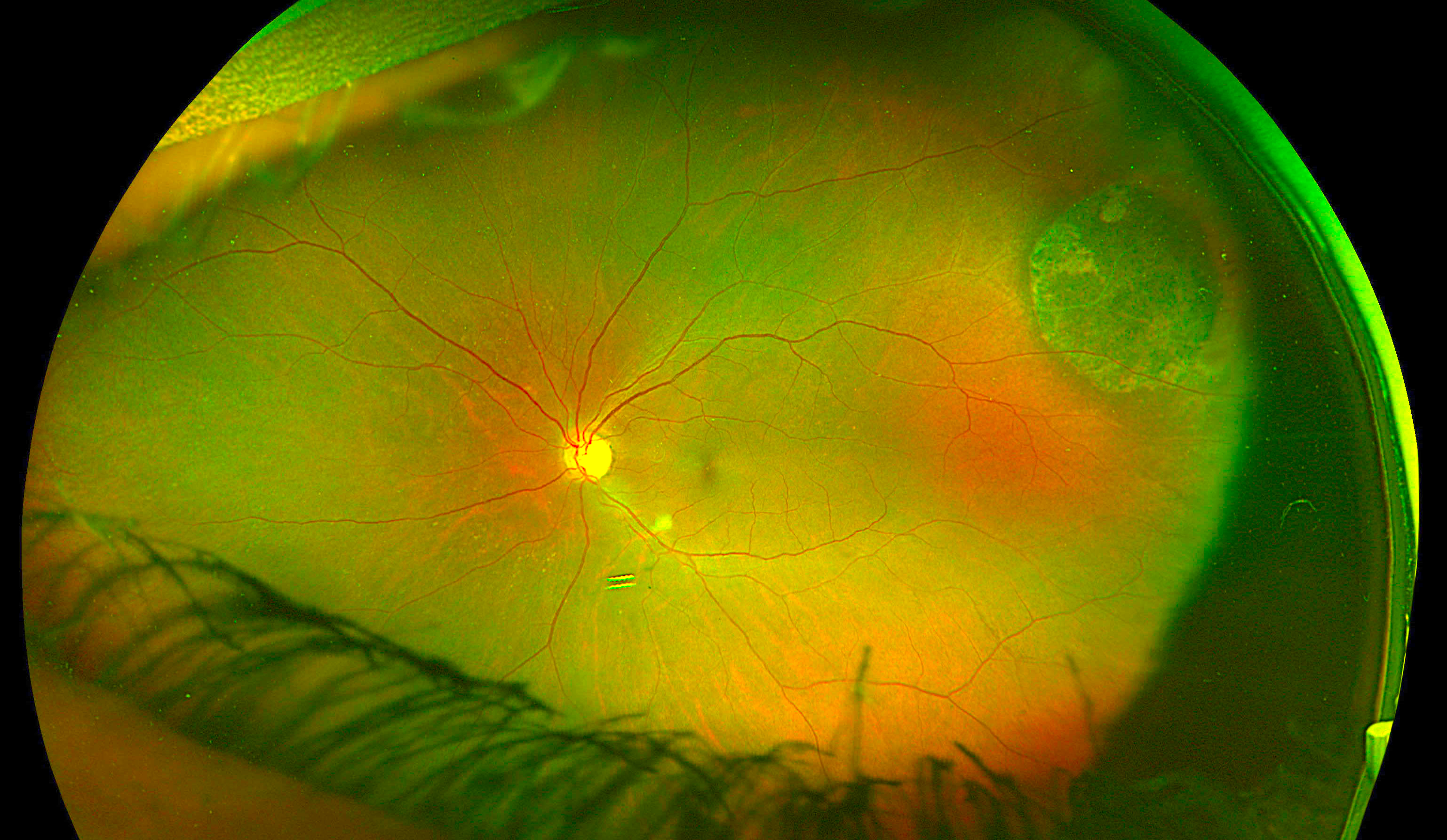 Optos fundus photo of a 57-year-old female featuring congenital hypertrophy of the retinal pigment epithelium (CHRPE) in the superotemporal periphery discovered incidentally on peripheral retinal examination.