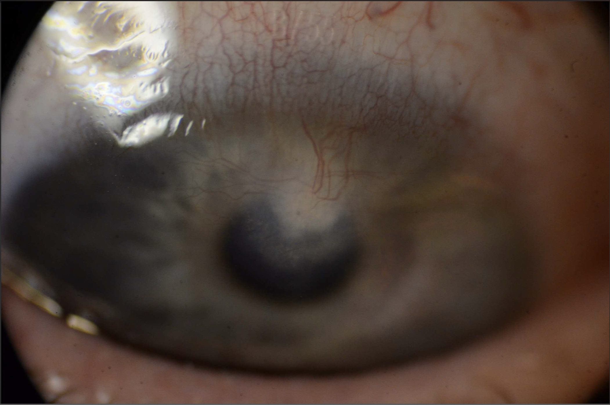 Slit lamp photograph of the right eye in inferior gaze showing crystalline infiltrate at the superior hinge of LASIK flap extending into the paracentral cornea with superficial and deep neovascularization.