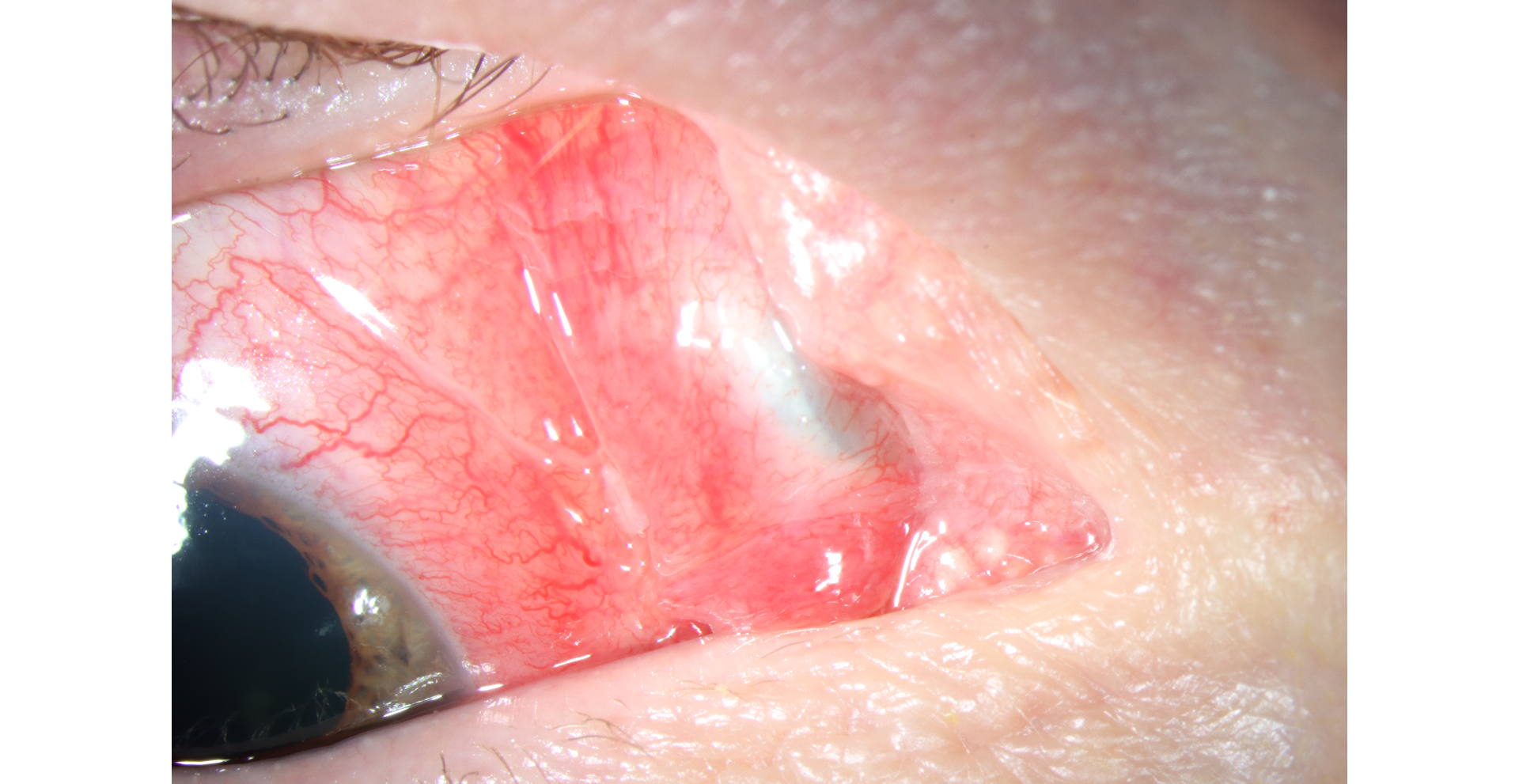 A subconjunctival metallic foreign body is seen posterior to a scarred area of the plica semilunaris representing a likely entry wound that had self-sealed
					  