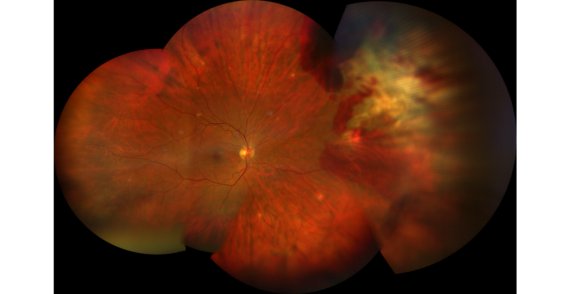 Fundus exam showed vitreous hemorrhage overlying hypopigmented retina consistent with chorioretinitis sclopetaria in the nasal and superonasal aspects of the far periphery