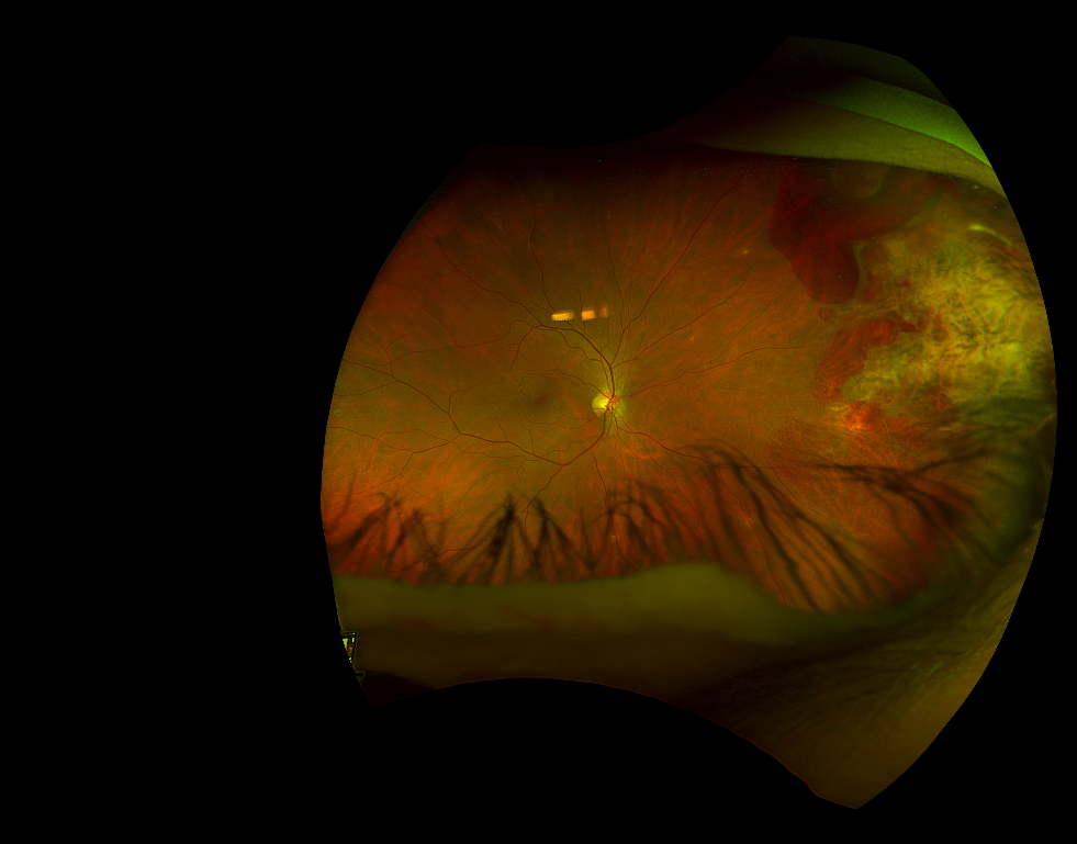 Fundus exam showed vitreous hemorrhage overlying hypopigmented retina consistent with chorioretinitis sclopetaria in the nasal and superonasal aspects of the far periphery