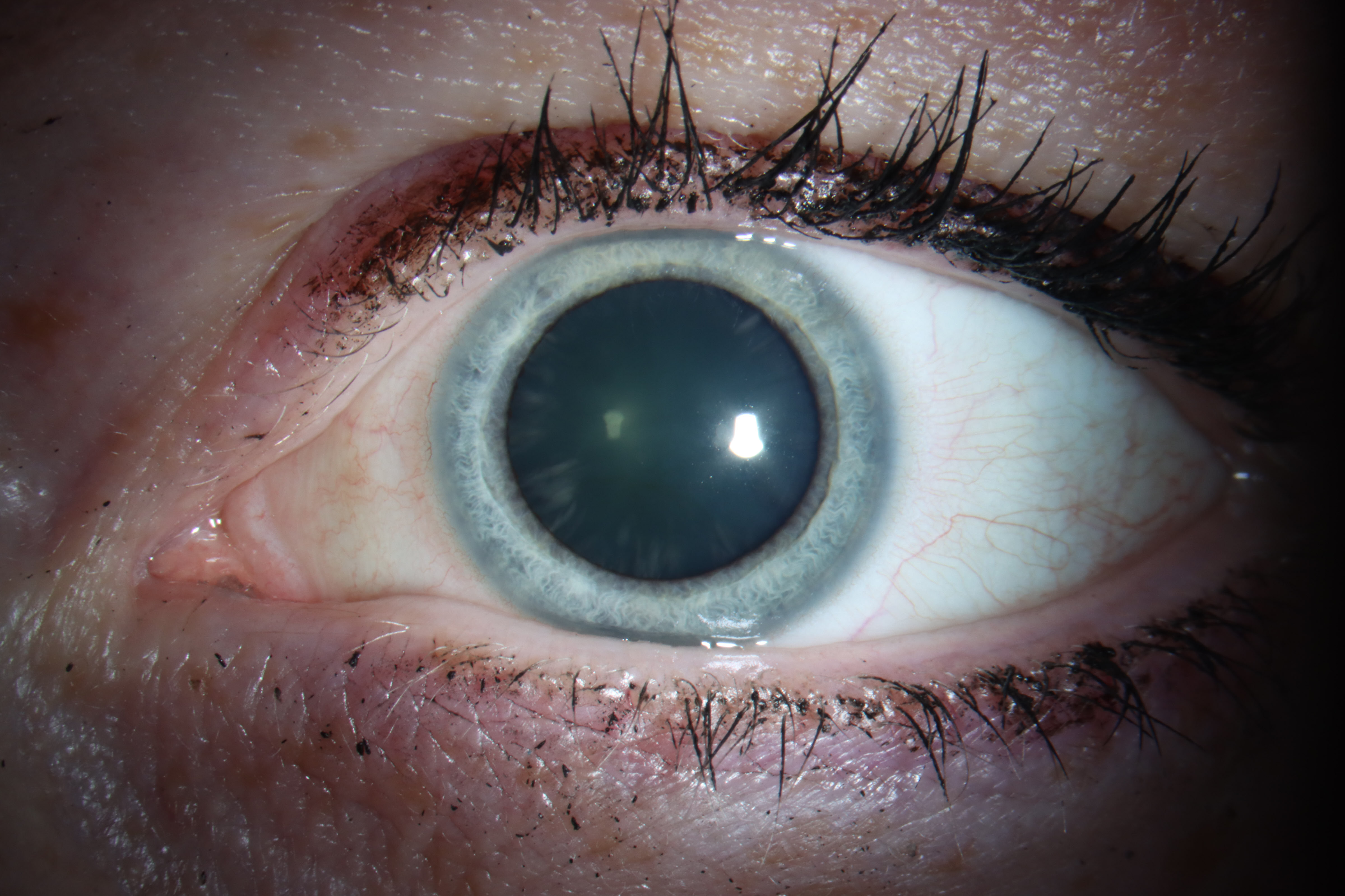 Dilated funduscopic examination showed severe, diffuse optic atrophy OD and bow-tie (band) optic atrophy OS