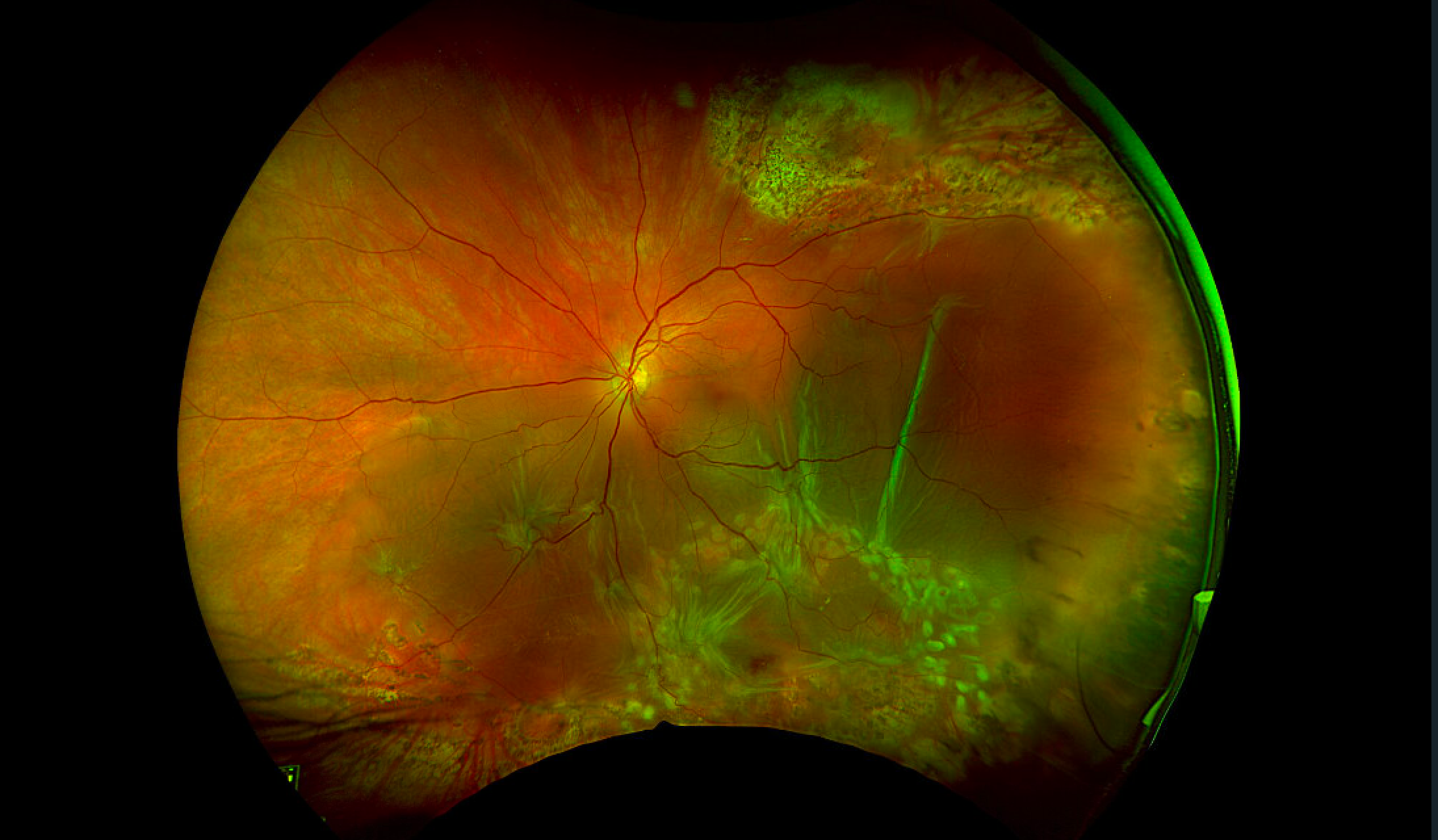  Wide-field pseudocolor fundus photograph, left eye. There is a macula-involving retinal detachment due to inferior proliferative vitreoretinopathy with multiple star folds. There are laser scars from barricade of a prior retinal tear (superiorly) and detachment (inferiorly).