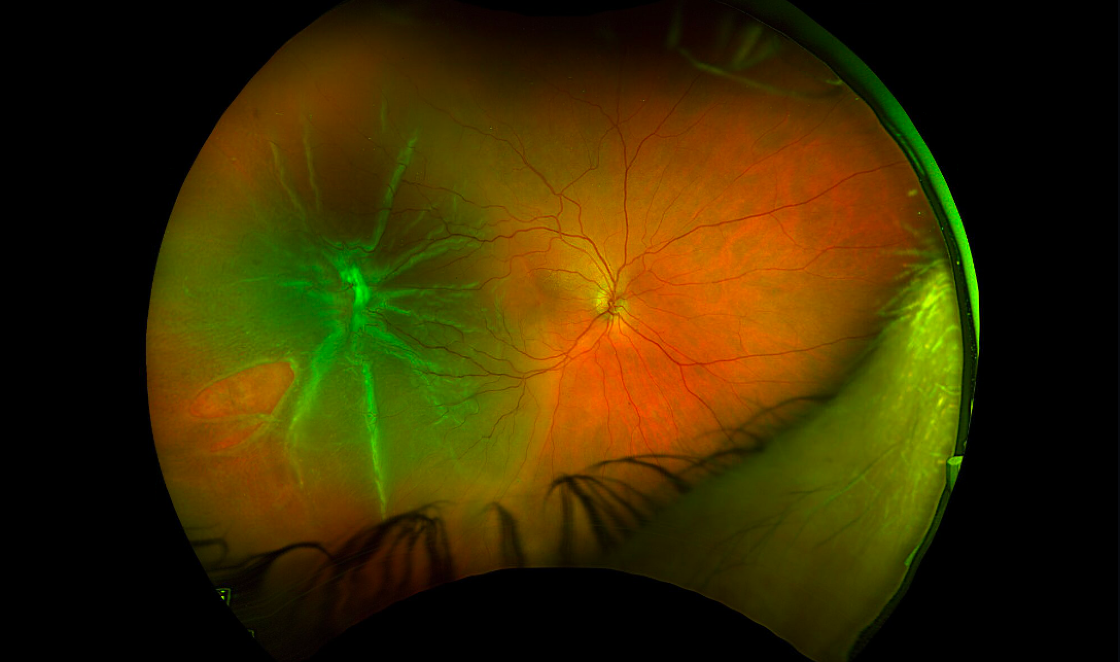 Wide-field pseudocolor fundus photograph of the right eye shows a macula-involving rhegmatogenous retinal detachment associated with a prominent star fold temporally and a retinal tear in the inferotemporal periphery