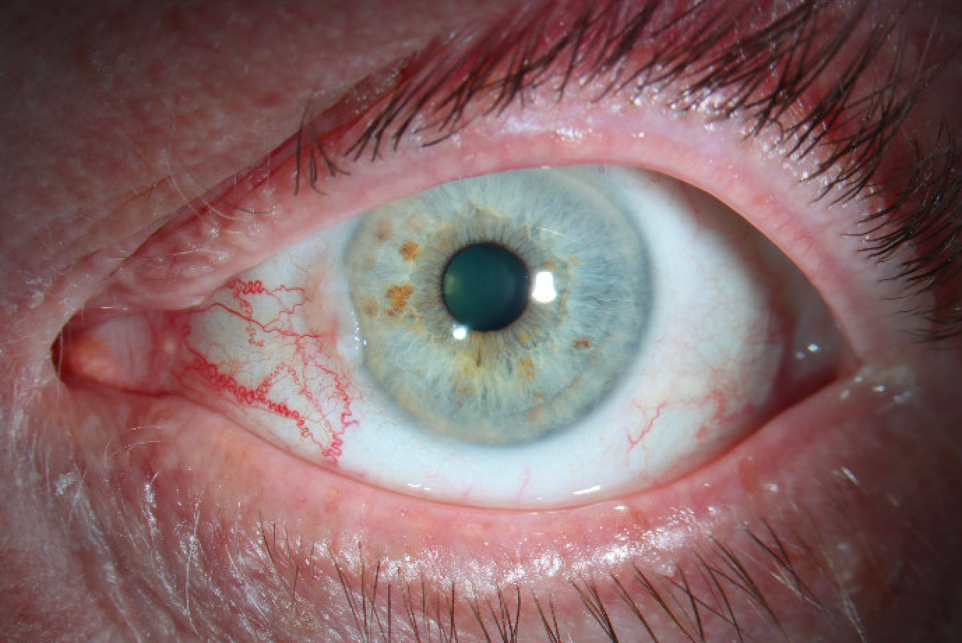 Slit lamp photograph of the left eye demonstrates a nasal, elevated, gelatinous, flesh-colored conjunctival lesion with leukoplakic areas extending approximately 1 mm onto the cornea, along with prominent nasal vessels.
