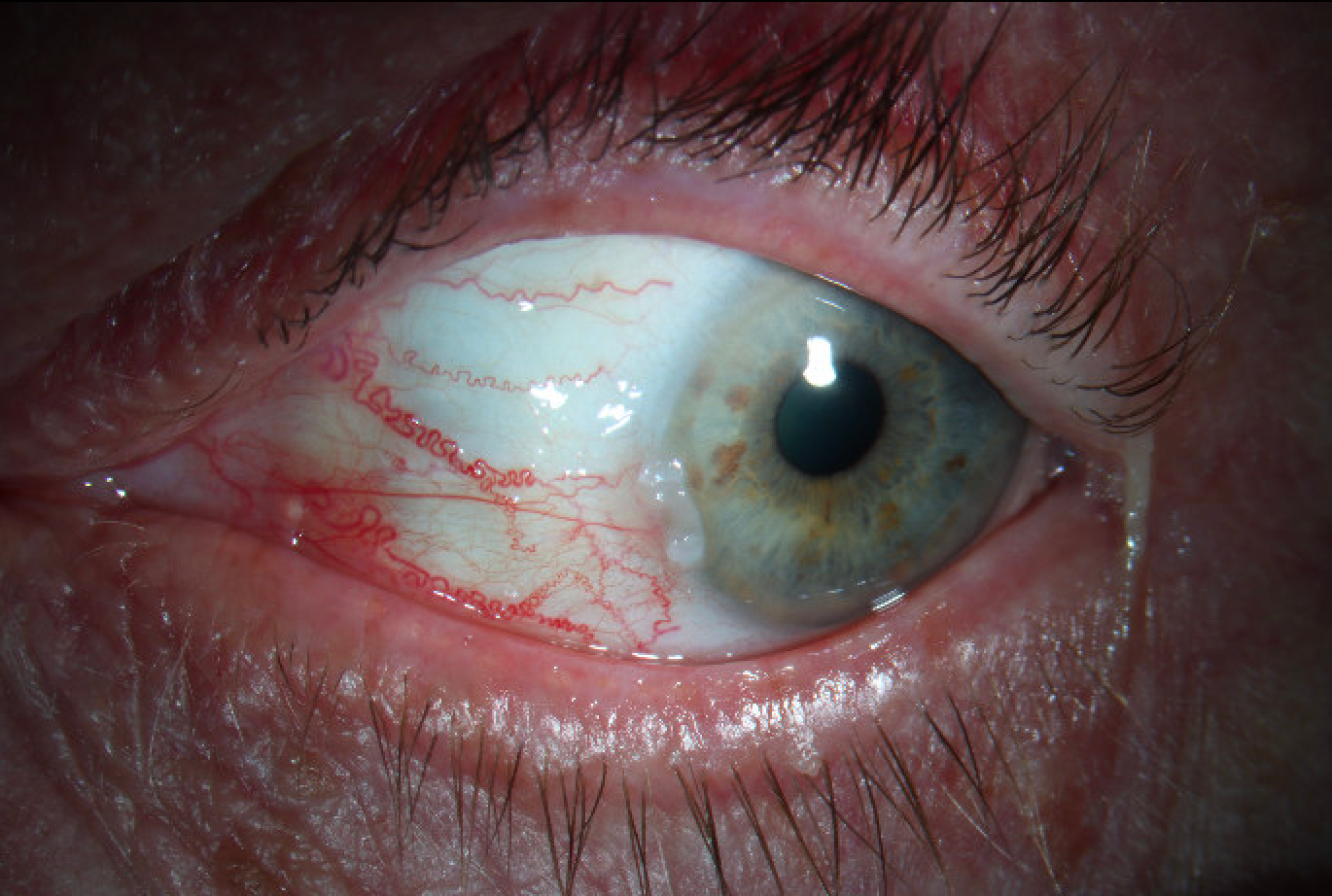 Slit lamp photograph of the left eye in lateral gaze demonstrates a nasal, elevated, gelatinous, flesh-colored conjunctival lesion with leukoplakic areas extending approximately 1 mm onto the cornea, along with prominent nasal vessels.
