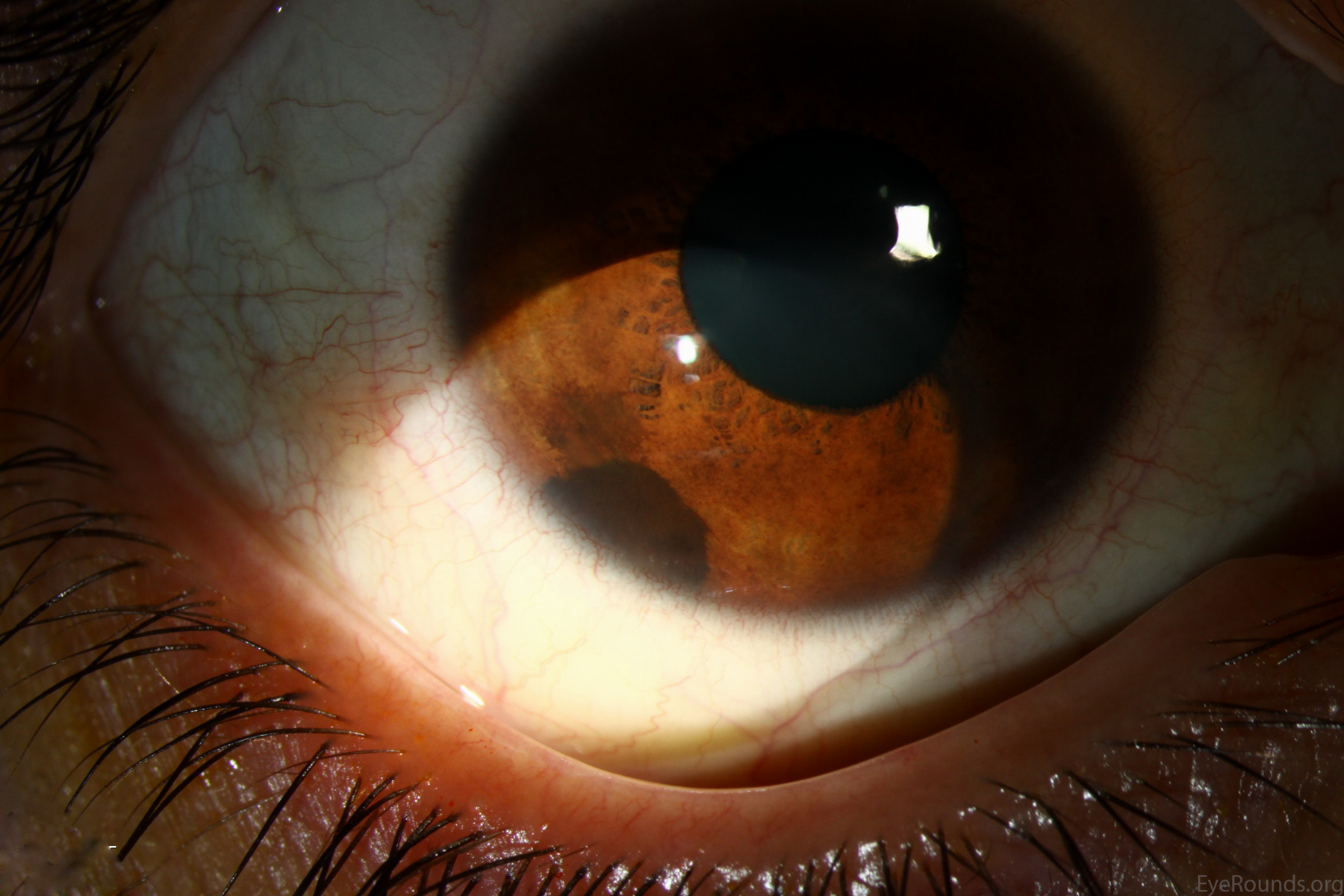 Dilated funduscopic examination showed severe, diffuse optic atrophy OD and bow-tie (band) optic atrophy OS