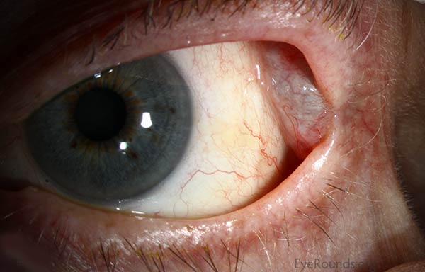 Lacrimal gland dacryops