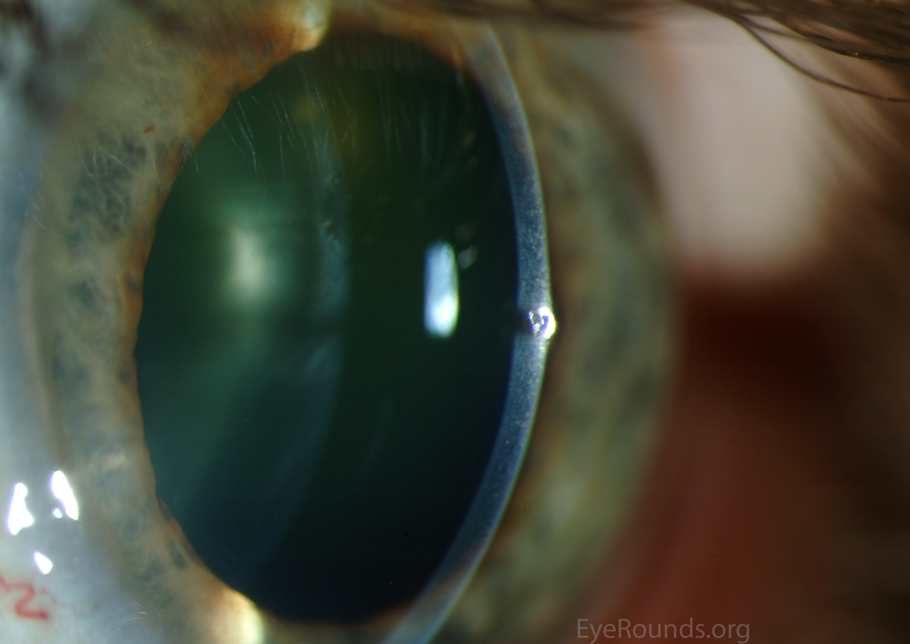 Slit lamp of metal foreign body in eye