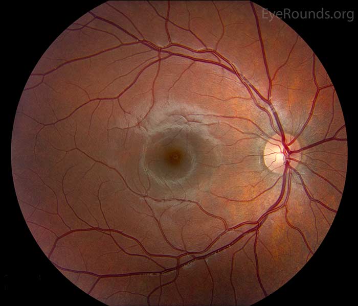 Related Atlas Entry:  Normal fundus in childhood