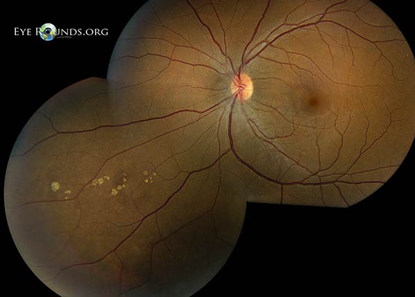 Grouped congenital albinotic spots of the retinal pigmented epithelium