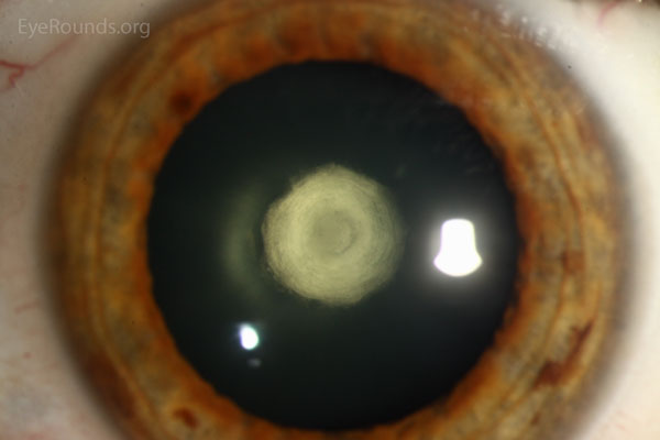 posterior subcapsular polar age related cataract bilateral icd 10