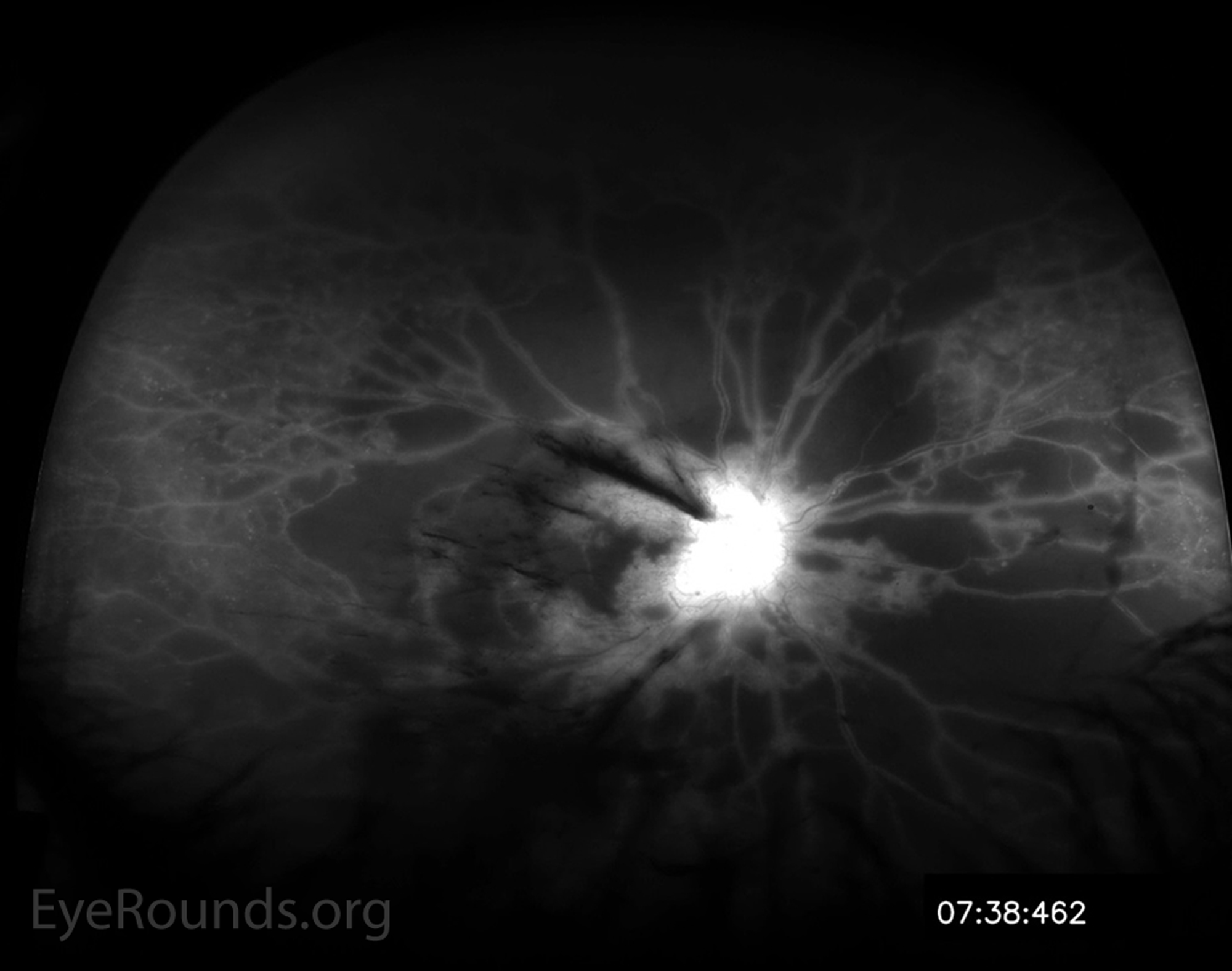 Figure 3.  Optos® widefield fluorescein angiography