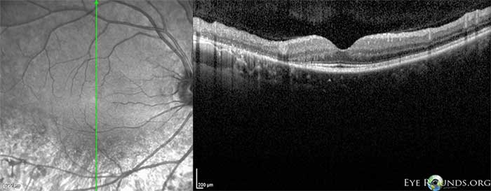 Sectoral retinitis pigmentosa