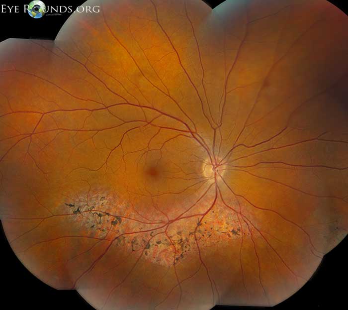 Sectoral retinitis pigmentosa