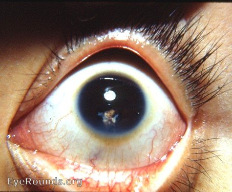 Microcornea with after-cataract following needling of congenital cataract