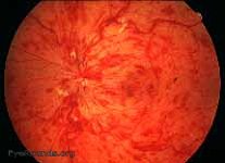 Non Ischemic Central Retinal Vein Occlusion Article