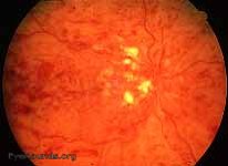 Ischemic Central Retinal Vein Occlusion Article
