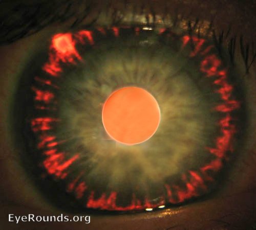 Iris transillumination defects in a radial pattern