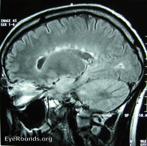 MRI showing MS
