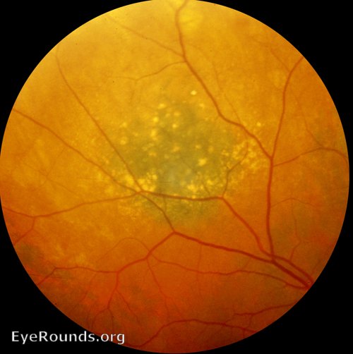 Choroidal Nevus With Lipofuscin