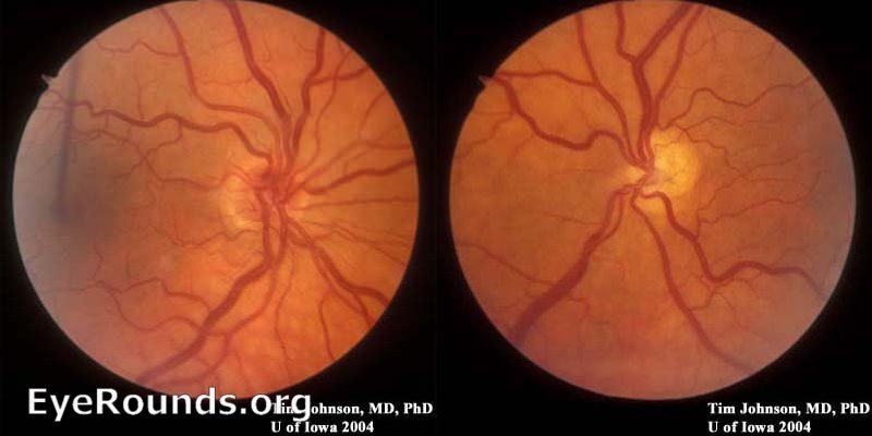 Atlas Entry Optic Nerve Hypoplasia