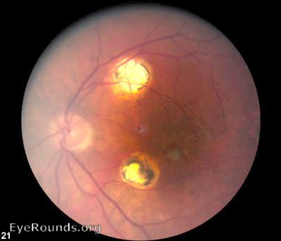 Patient had PRP laser to destroy macular lesions.