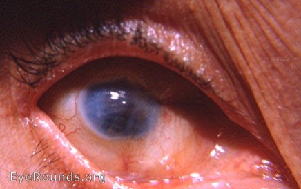 cataract: Post-0p phthisis bulbi