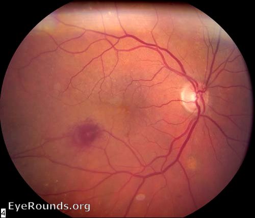 retinal arterial macroaneurysm (RAMA)