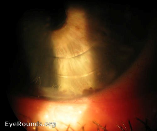 retinal detachment - Shafer's sign