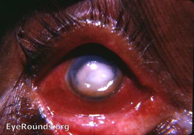 Ulcus serpens/hypopyon ulcer/abscess of cornea