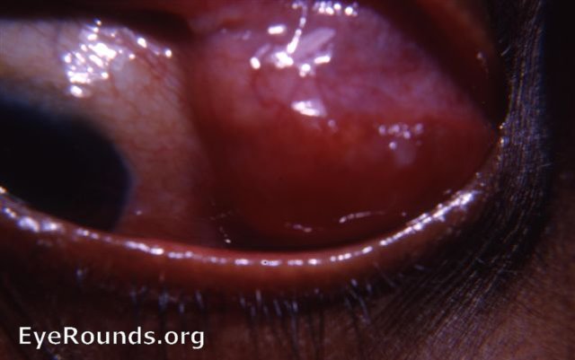 Lacrimal gland tumor OS