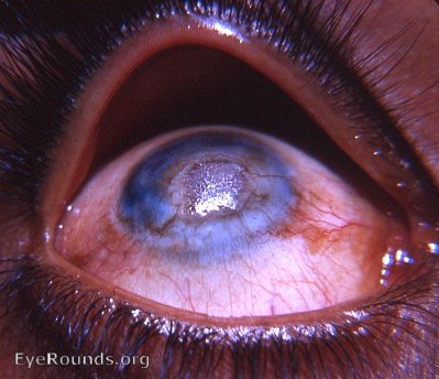 Xerotic plaque in center of neovascularized corneal leukom