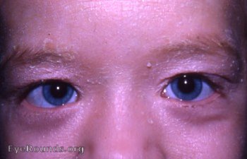 congenital ichthyosis with bilateral ectropion