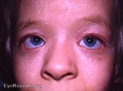 congenital ichthyosis with bilateral ectropion