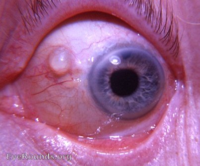 benign neonatal ocular flutter