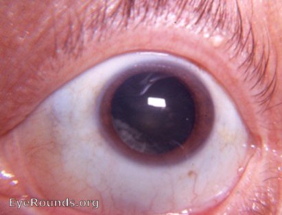 cataract: mature corticonuclear cataract