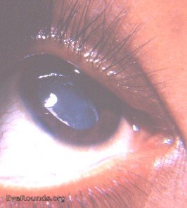 iridodialysis: traumatic with traumatic cataract