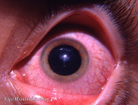 scarring of the cornea at the apex of the keratoconus