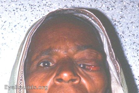 Lacrimal gland: tumor with medial displacement of eyeball