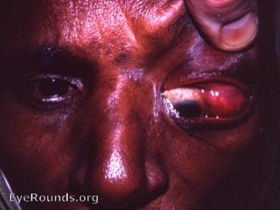 Lacrimal gland: tumor with medial displacement of eyeball