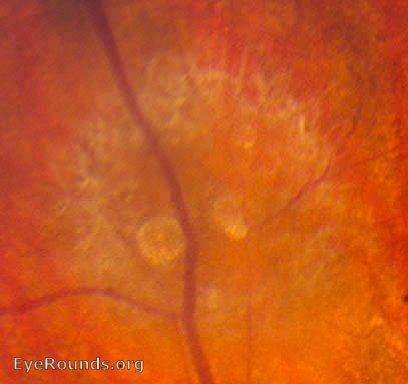 Fundus close up Astrocytic harmartoma: white, semitransparent, mulberry-appearing tumor of retina or ON. Calcification with age. Occurs in the CNS.