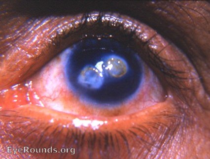 corneal ulcer scar