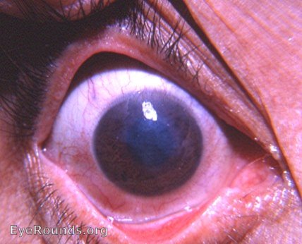 scar in eye retina