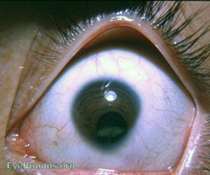 Microcornea, coloboma of iris, and cataract