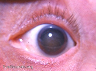 cataract: mature corticonuclear cataract