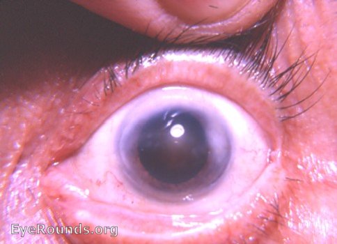 cataract: nuclear sclerosis vs nuclear cataract