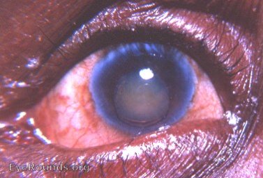 cataract- a shrunken Morgagnian cataract has slipped into the anterior chamber