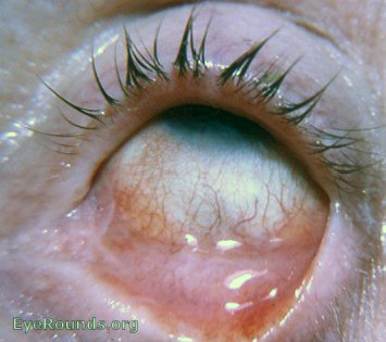 trachoma: pemphigoid-like trachoma with trichiasis