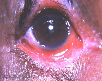 trachoma: pemphigoid-like trachoma with trichiasis